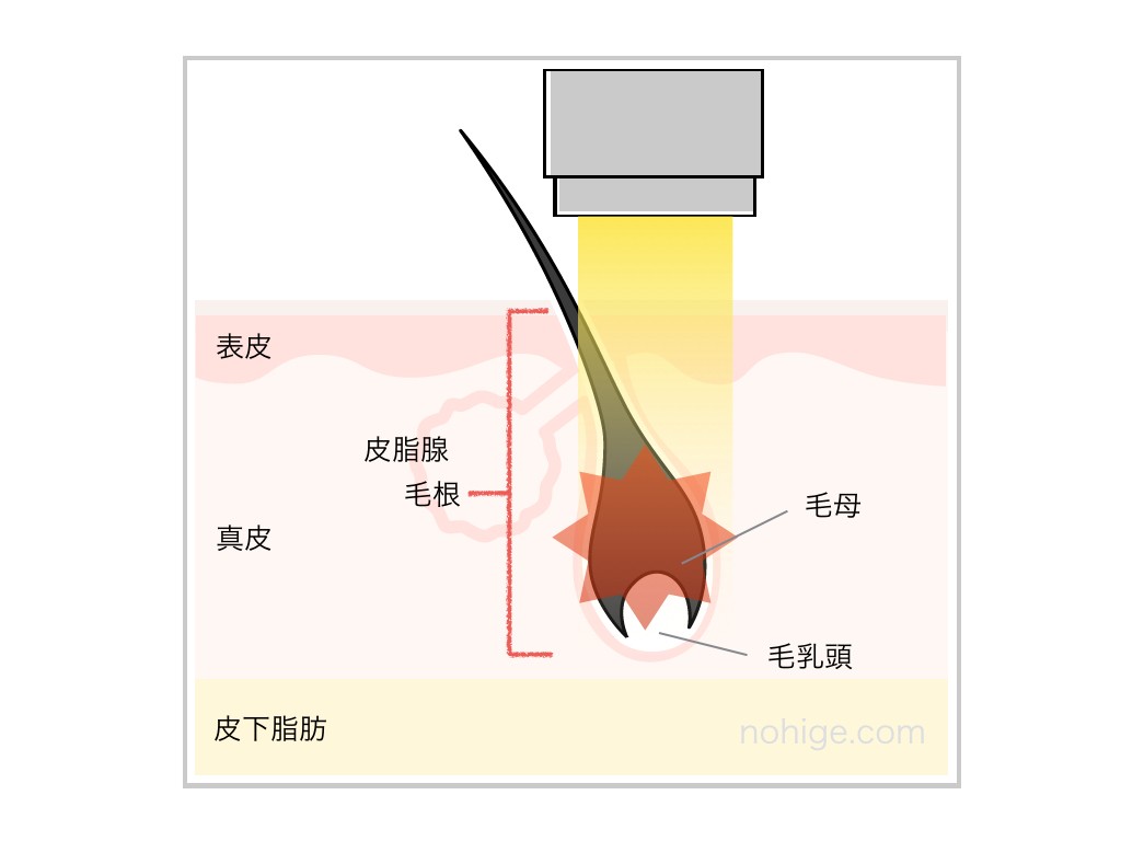 レーザーが毛根のメラニン色素に反応して熱で発毛器官を破壊